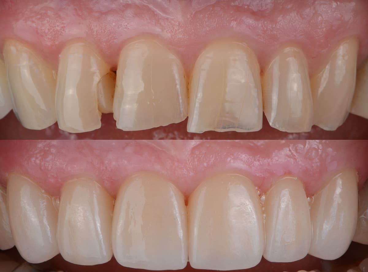 Crown / Bridge / Veneer