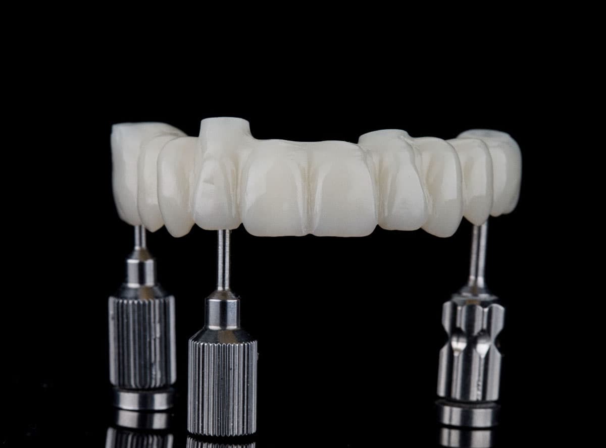 Temporary / Diagnostic Wax Up