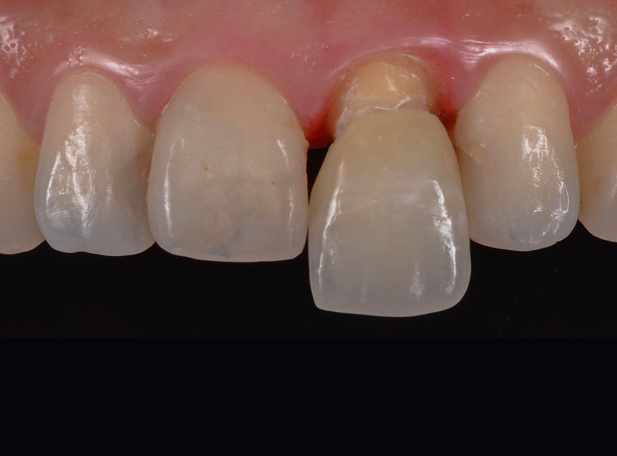 Crown / Bridge / Veneer