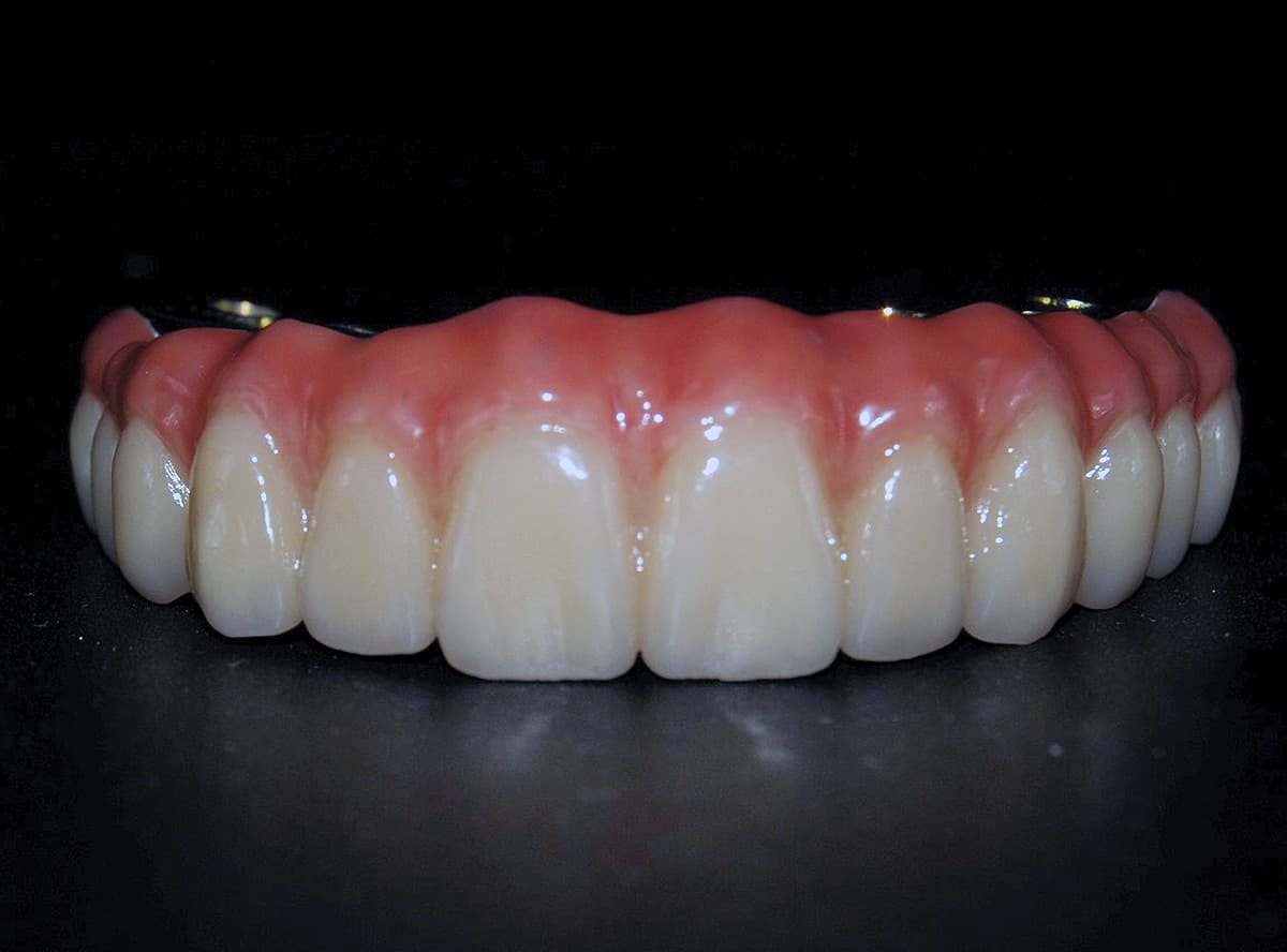 All-On-X/Implant Bars