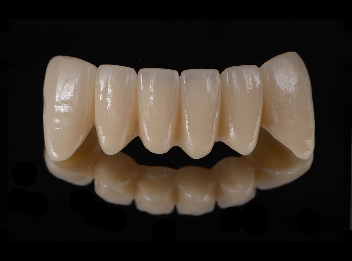 Crown / Bridge / Veneer
