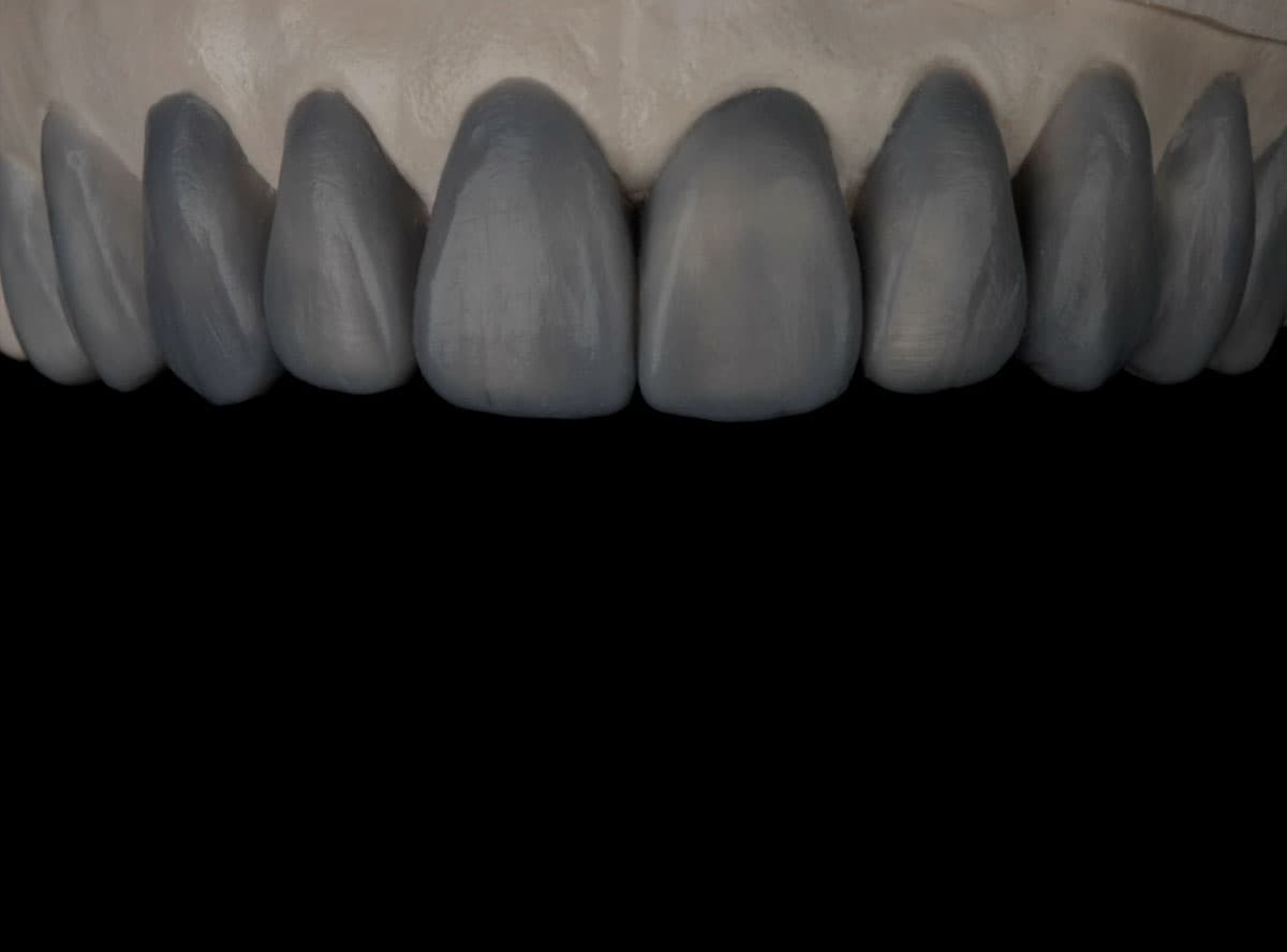 Temporary / Diagnostic Wax Up