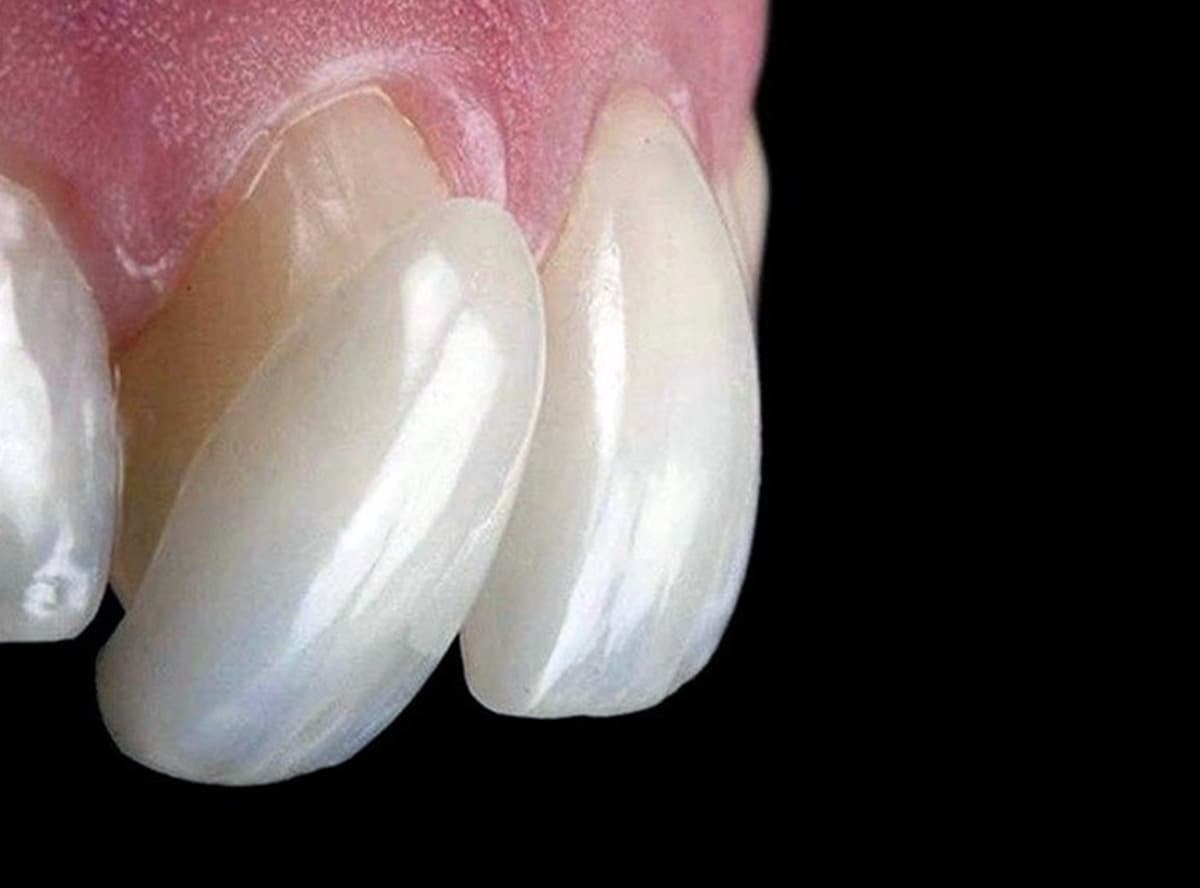 Crown / Bridge / Veneer